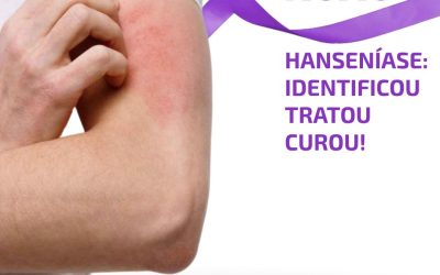 Hanseníase: identificou, tratou, curou!